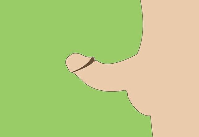curvatura del pene come indicazione per l’ingrandimento chirurgico